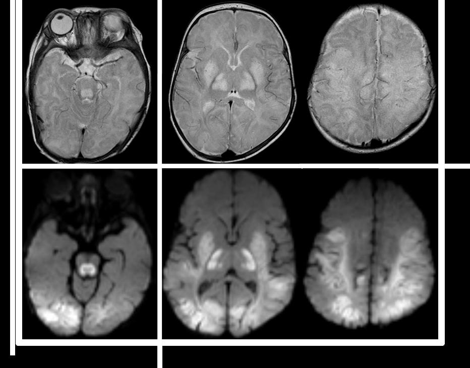 Symmetriskt ökad T2-signal i BG, hjärnstam och thalami.