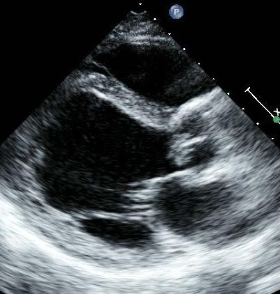 Fall #3: Native aorta IE Man, 57 år, BMI 19 Mb Crohn, tarm op 2 ggr Viktnedgång,