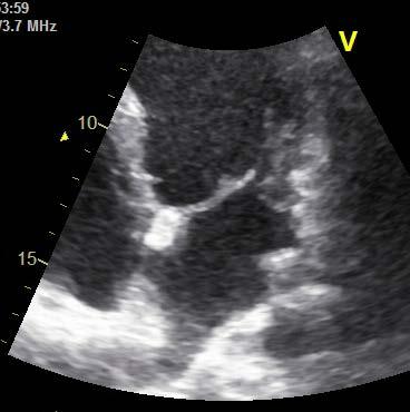 Fall #6: Native mitral