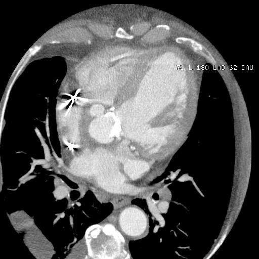 Fall #15: Aortaprotes IE Med