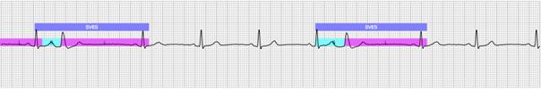 Kategori 10 Fler än 5 supraventrikulära extraslag (SVES) detekterade över 30 sekunder (endast 10 sekunder i ovanstående EKG).