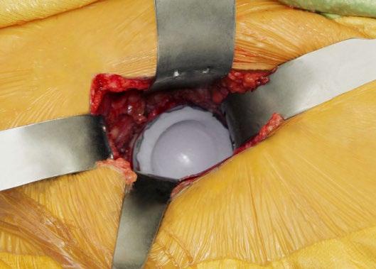 NOTE: Frame may be left in place while broaching the femur.