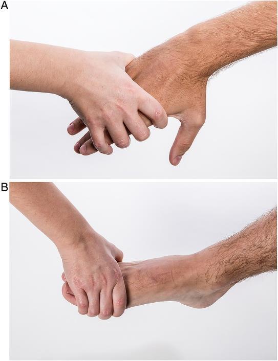 Progression to Rheumatoid Arthritis.