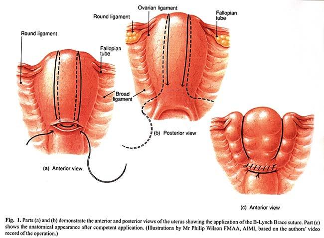 cervix och vagina Ballongtamponad