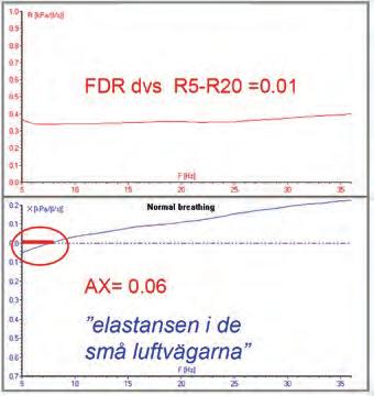 FDR dvs R5-R20 =0.01 FDR dvs R5-R20 =0.25 Normal andning Normal andning AX= 0.06 «elastansen i de små luftvägarna» AX= 1,86 FIGUR 8.