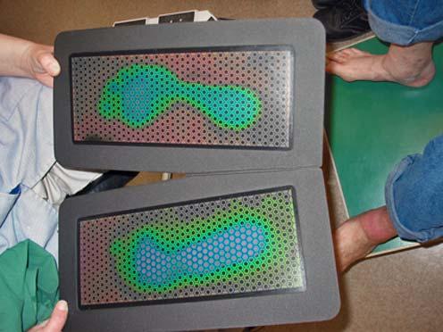 Bild 3: Undersökning av fotstatus med SpectraSole Pro 1000. Temperaturökning i vänster fot som kan vara osteoartropati.
