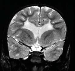 Bilateral spastisk CP 180 160