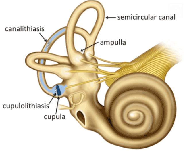 BPPV