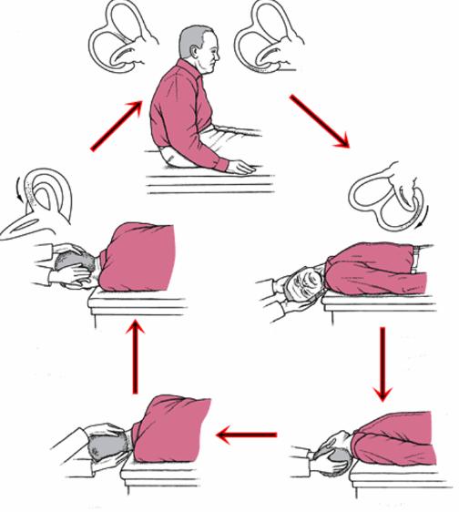 BPPV (Godartad lägesyrsel) Behandling Epley