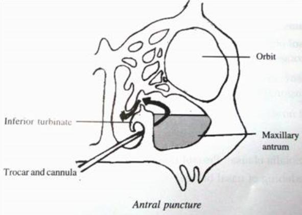 Sinuit (bihåleinflammation) Vanlig Etiologi: Ofta övre luftvägsinfektion (ÖLI). Näspolyper. Nasal cancer.