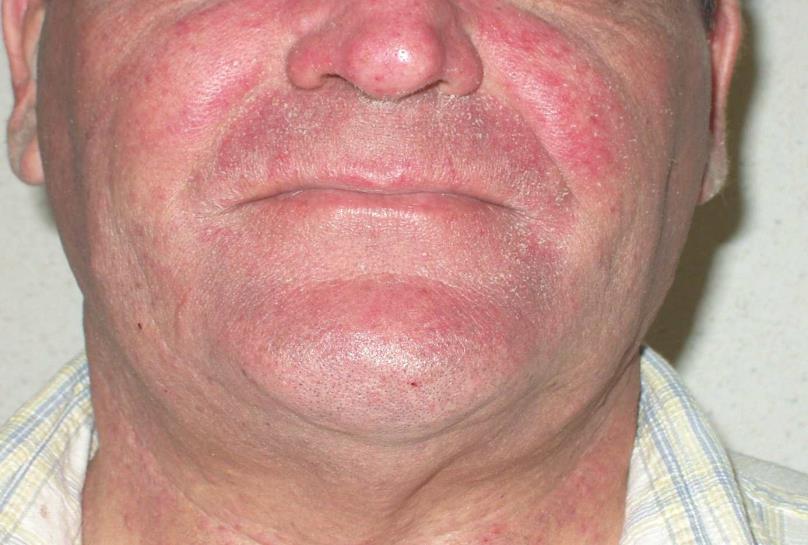 Torr hud (xerosis) Utvecklas gradvis, kan uppstå efter flera veckors behandling och kan medföra klåda. Kan uppträda var som helst på kroppen men mest förekommande på hals, ansikte och bål.