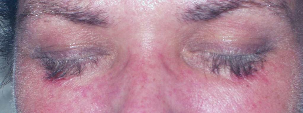 Hand-fot syndrom Hår/ögonfransar Hårförändringar uppkommer vid långtidsbehandling. Hårstrukturen ändras och blir finare och mjukare samt ögonfransarna kan bli längre och i vissa fall falla av.