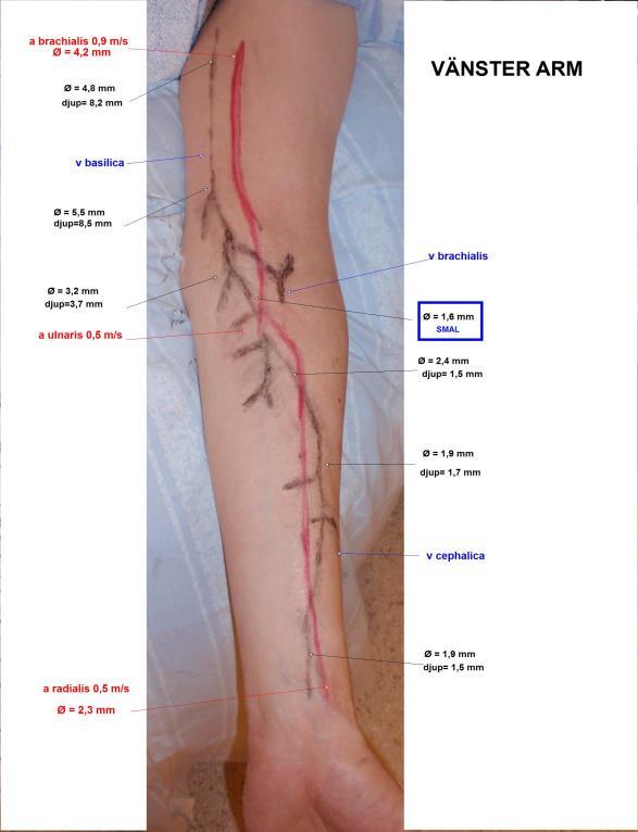 Bedömning: V cephalica är normalbred på underarmen med avrinning via v brachialis i armvecksnivå samt till v basilica strax under armvecksnivå.