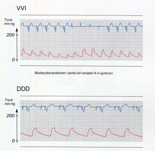 Figur 22 DDD pacemaker som omprogrameras till VVI Figur 23 Behandling med VVI och DDD pacemaker. Aortatrycket avbildas med rött.