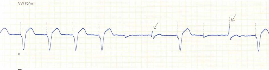 defibrillator 1.