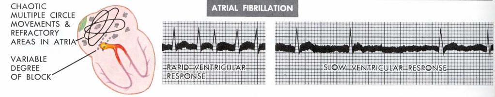 Förmaksflimmer Atrial Fibrillation Courtesy Novartis Pharma Reproduced with AF Suppression > 90% av tiden stimuleras