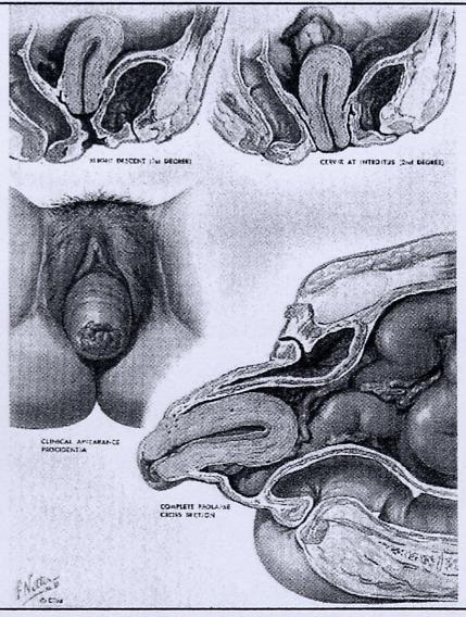 Korrektion för prolaps av uterus