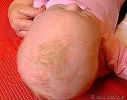 Måttlig klåda Hos barn med seborroiskt eksem finns det en överproduktion av hudsvamp(pityrosporum) och en