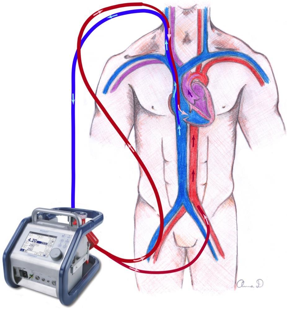 Andra kanyleringar vid respiratorisk svikt VAV-ECMO Om patienten, förutom sin grava respiratoriska svikt även har cirkulatorisk svikt kan omkoppling till en veno-arterio-venös ECMO vara bra.