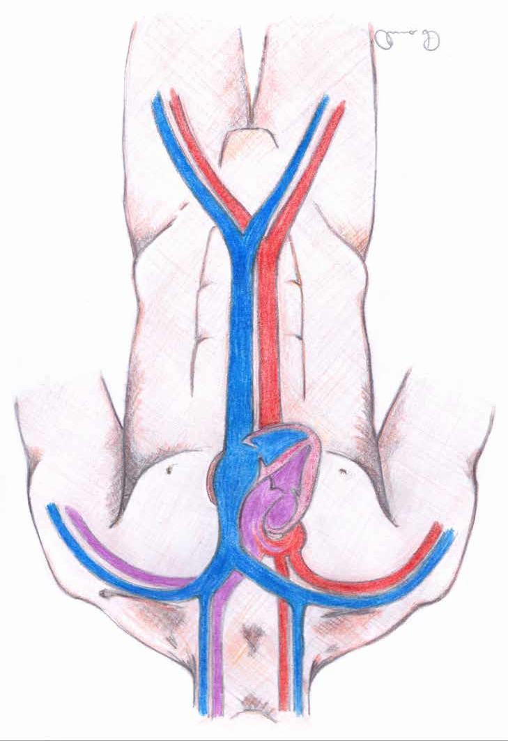 Cirkulatorisk svikt Perifert kanylerad VA-ECMO När man snabbt behöver starta VA-ECMO kanyleras oftast vena och arteria femoralis, eftersom de är grova och ofta ganska lätta att hitta.