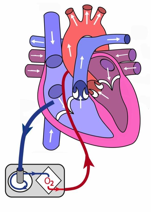 Centralt kanylerad VA-ECMO Om patientens hjärta inte klarar ta över cirkulationen efter ECC kan centralt kanylerad VA-ECMO hålla patienten vid liv.