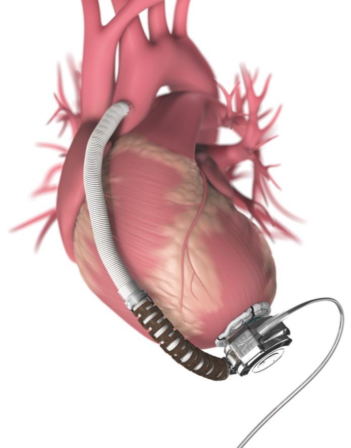 På grund av dess ringa storlek kan man även sätta in den via en liten thorakotomi med tunnellering av utflödetsgraftet upp till aorta.