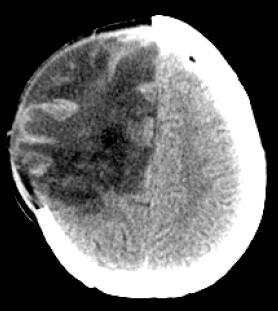 Brain volume regulation A. in normal brain with intact BBB (top) C.