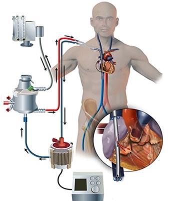 15 fall vårdade i ECMO Flest fall sedan 2009 under högsäsong >10 fall/vecka ECMO-nära Unga, utan riskfaktorer 9 patienter <40