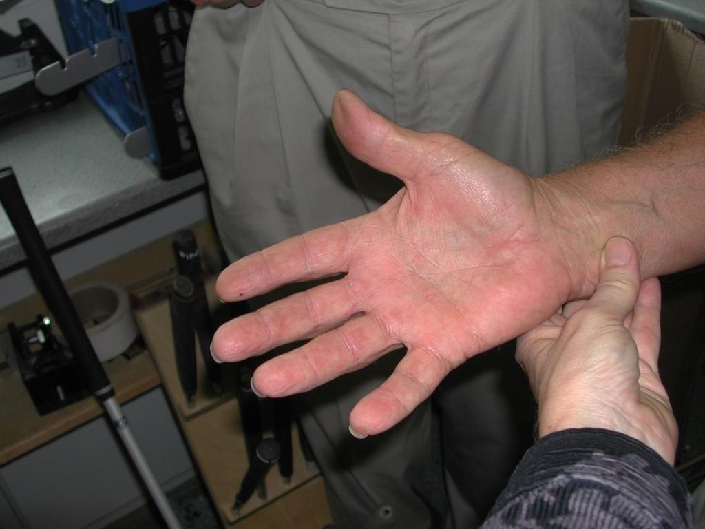 Epoxy resin case report 2 Isaksson, Möller, Pontén. Occupational Allergic Contact Dermatitis from Epoxy Resin in a Golf Club Repairman.