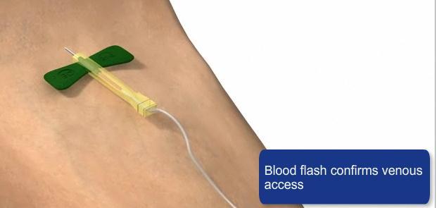 11. BD Vacutainer Safety Lok TM blodprovtagningsset Denna modul förklarar egenskaperna av BD Vacutainer Safety-Lok venprovtagningsset.