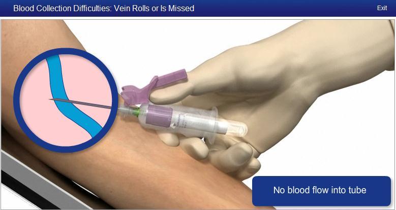 4. Svårigheter vid venös blodprovstagning Målet med denna modul är att belysa svårigheter som kan uppstå och visa hur man övervinner dem.
