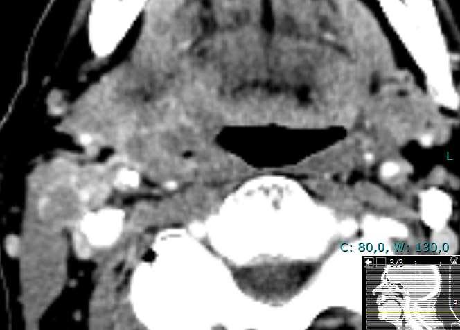 Metastaskonglomerat