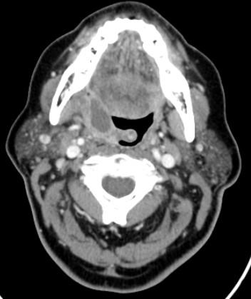 Peritonsillär abscess Bild- och