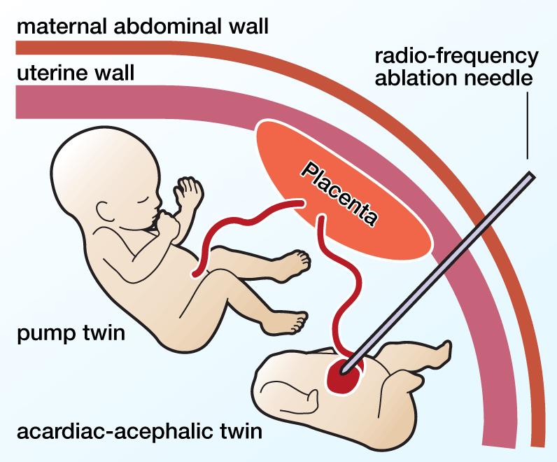 TRAP (twin reversed arterial perfusion sequence) 1% monokoriota tvillingar acardiac tvilling och en pump tvilling