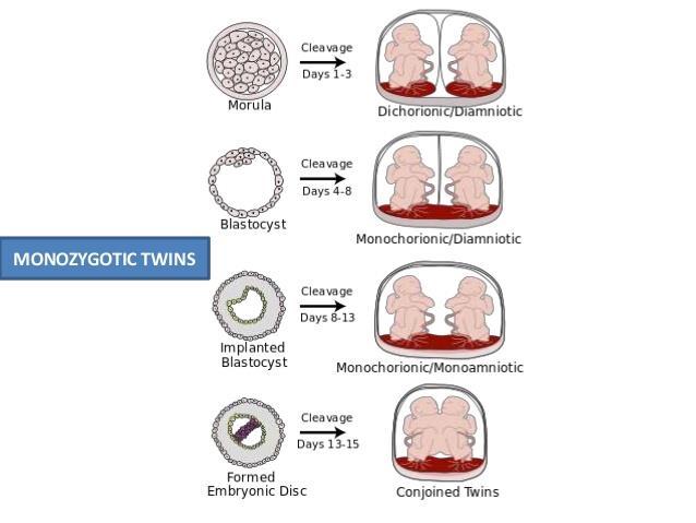 2) Enäggstvillingar (monozygota) 10% av alla tvillingar. Okompliserad. 2 placentor.