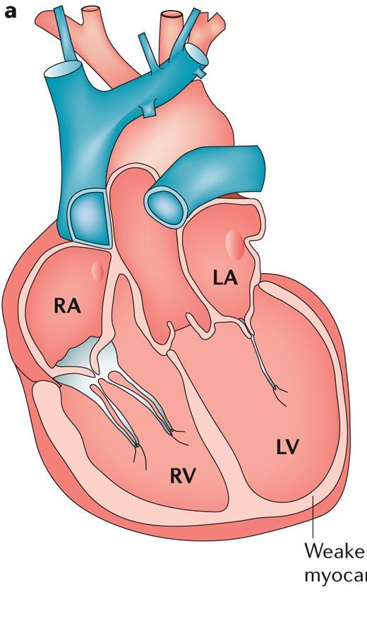 HFrEF HFpEF Förmaksförstoring till följd av förhöjda fyllnadstryck Högersvikt (sekundär/primär?