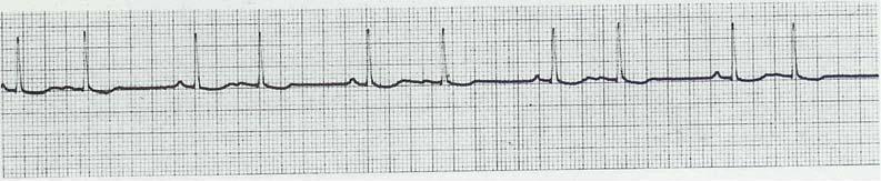 Fråga 2 totalt 6 poäng Du har flera patienter som kommit till vårdcentralen där du arbetar. Du tar EKG på dem.