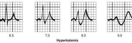 Hjärta Snabbare kammarrepolarisering toppig T-våg Långsam kammardepolariesering 1. Breddökat QRS 2.