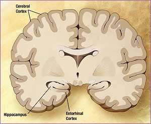 Hjärnförändringar Sjukdomen börjar alltid i entorhinalcortex (luktnervens primärcortex) vid hippocampus i mediala temporalloberna Sprids sedan på ett anmärkningsvärt konstant sätt till resten av