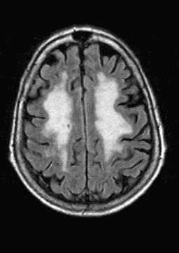 Vaskulär Demens, småkärlssjuka För att sätta diagnos