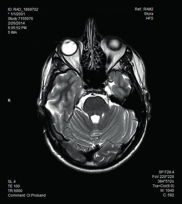 Den vänstra bilden visar artefakter som erhålls när implantatets magnet sitter på plats medan den högra bilden illustrerar bildartefakter na när implantatets