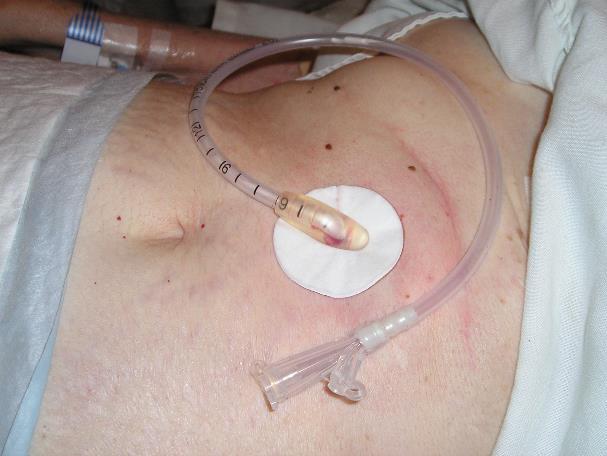 PEG- Perkutan Endoskopisk Gastrostomi Gastrostomi är en kanal genom huden direkt till magsäcken. I denna kanal sätts en PEG (näringsslang) genom vilken man kan tillföra näring (se bild 1).
