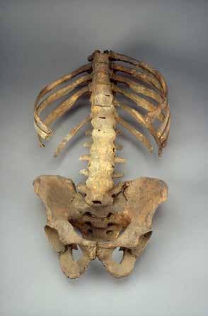 HISTORIA MED IDO Reumatologins framväxt i Norden Figur 8. Visbymannen levde i Visby någon gång mellan 900 och 1100. Han är sannolikt nordens äldsta kända fall med pelvospondylit (Mb Bechterew).