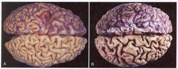 Åldersatrofi av hjärnan Involution Fysiologisk mekanism att reducera organstorlek genom apoptos