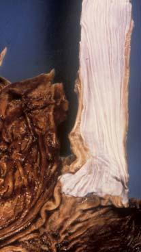 cervix uteri efter papillomvirus infektion Intestinal metaplasi