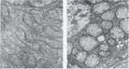 Ansamling av vacuoler och ökad cytoplasma volym Hydrop degeneration ökad vätskemängd i cytoplasman på