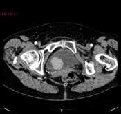 Det är dock vanligt att man får skiktning mellan kontrastmedelstillblandad urin och icke kontrastmedelstillblandad urin vilket kan försvåra bedömningen då tumörer belägna där urinen inte är