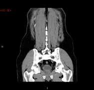 NY AVHANDLING Fig. 3: Tumör (pilar) i blåsans högra omfång i CMP (A) och EP (B). Tumören missades med flexibel cystoskopi men upptäckte med CTU.