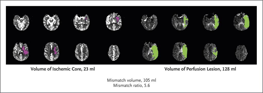 Example of Perfusion Imaging Showing a Disproportionately Large Region of Hypoperfusion as Compared with the Size of Early Infarction.