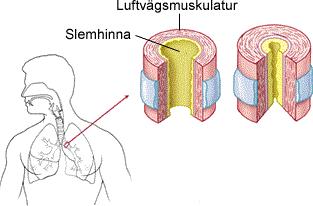 Frisk KOL - Kronisk (obotlig) - Obstruktiv (förträngning) - Lungsjukdom